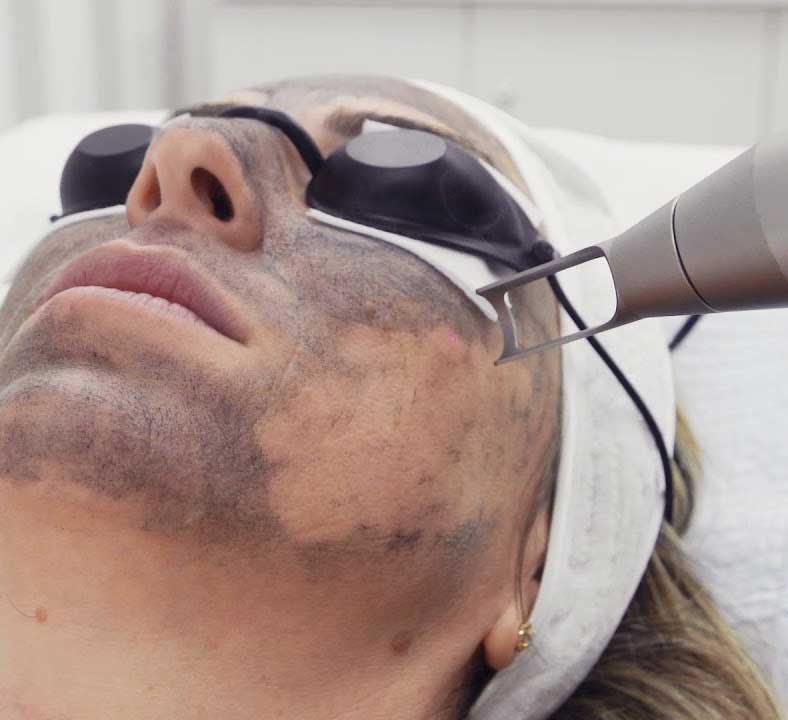 carbon peel treatment in bhopal