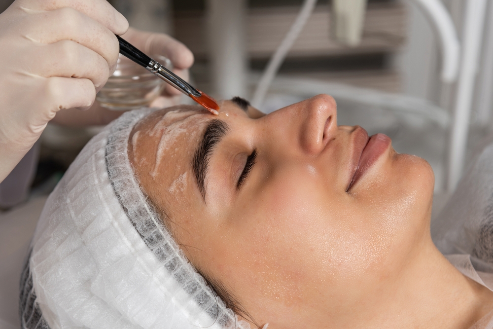 Chemical Peel treatment in bhopal