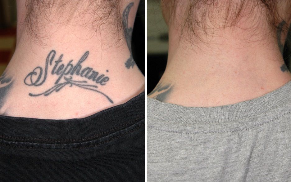 HIFU  treatment in bhopal